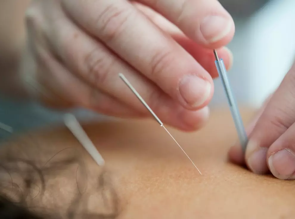 Acupuncture